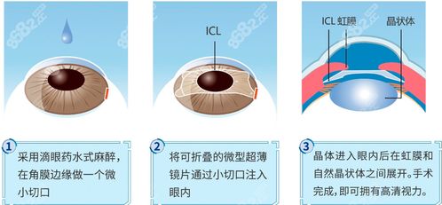 近视手术前要做哪些准备工作？